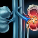 क्या पथरी में दूध-दही छोड़ना सही है? डॉक्टर से जानें किडनी स्टोन का असली डाइट प्लान